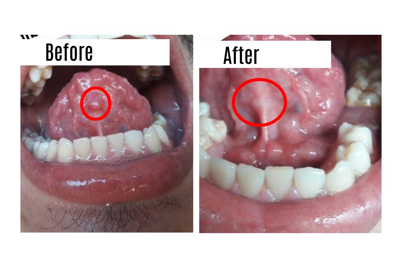 Mucocele