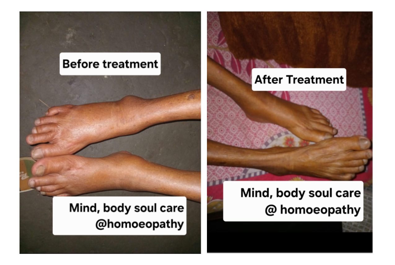 Gout Cure