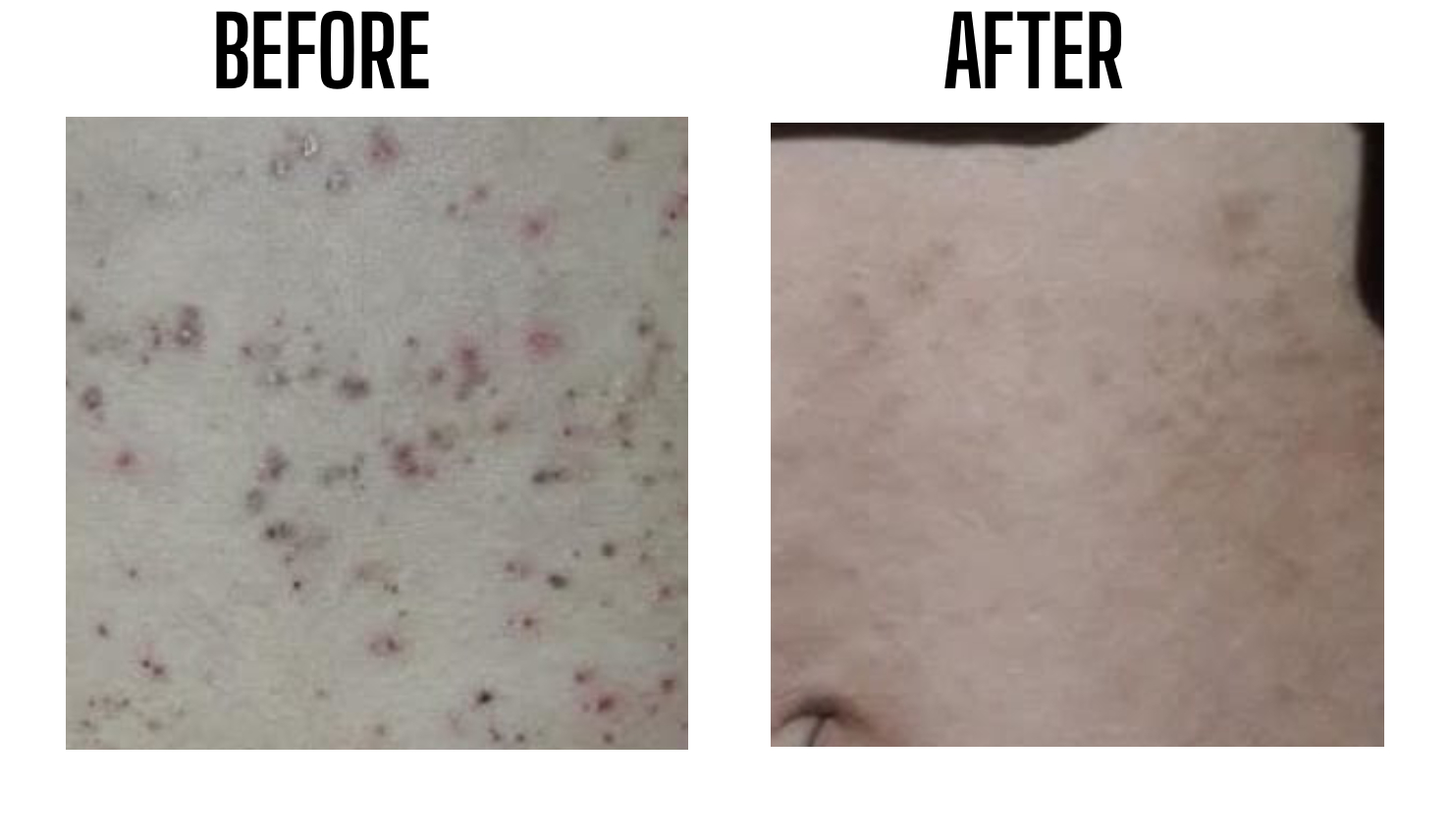 Foliculities of middle and lower trunk